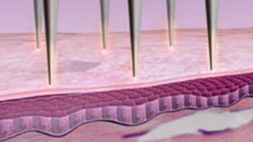 Technologia mikroigłowa RF zabiegu VoluDerm Legend