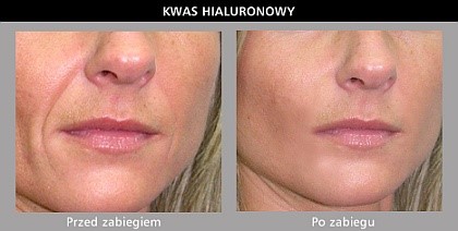 Kwas hialuronowy - przed zabiegiem i efekt po zabiegu