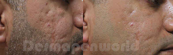 Dermapen - efekty zabiegu