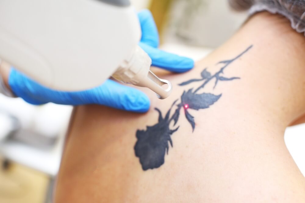 laserowe usuwanie tatuazu